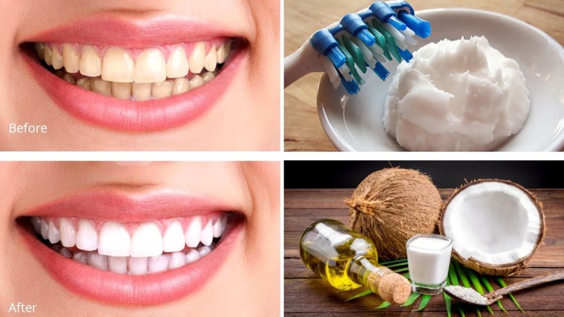 Achieve Whiter Teeth Like Your Favorite K-Drama Stars Using Virgin Coconut Oil